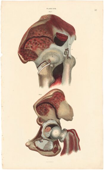 Lizars Pl. 47, Exterior and Interior View of the Hip-joint...