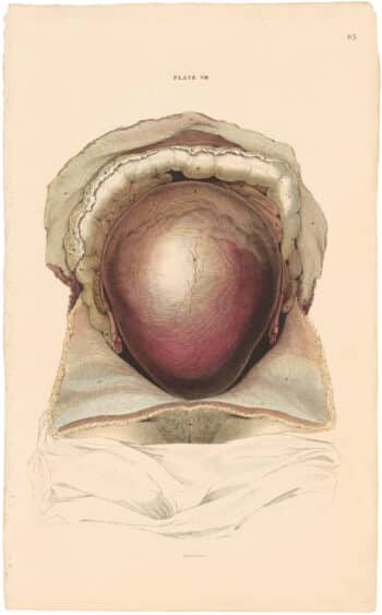 Lizars Pl. 95, View of the Gravid Uterus in situation