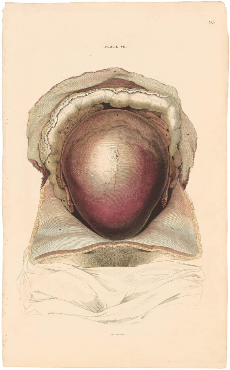 Lizars Pl. 95, View of the Gravid Uterus in situation