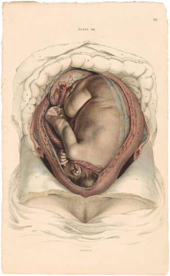 Lizars Pl. 96, View of the Fetus in Utero